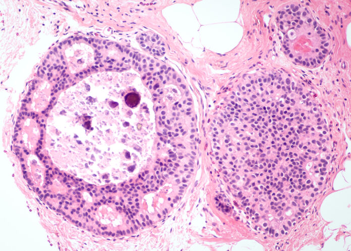 Breast,Cancer,Core,Biopsy,-,Ductal,Carcinoma,In,Situ,(dcis)