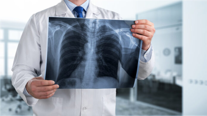 Doctor,Looking,Chest,X-ray,Film,In,Hospital.
